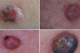 Cách nhận diện u ác tính giống hệt mụn thường