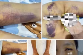 Người phụ nữ bị gia đình chồng cũ hành hạ dã man để... trừ tà