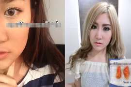 Gái xinh Thái Lan cắt thịt ở má làm cằm V-line