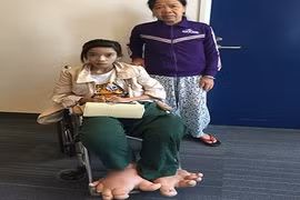 Nỗi khổ của thiếu nữ Huế mang đôi chân khổng lồ