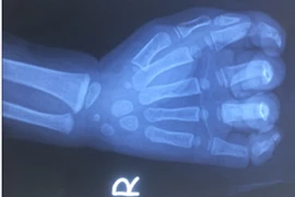 Bé trai 23 tháng tuổi nát cả bàn tay do bị cuốn vào dây coroa máy rửa xe