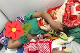 Quảng Nam: Một bé sơ sinh gãy xương đùi khi mổ lấy thai