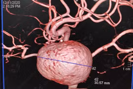 Người phụ nữ mang "bom máu" trong đầu