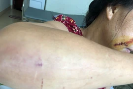 Vết thương trên người chị Thu.