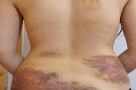 Thương tích trên người chị S. 