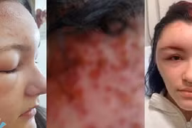 Nhuộm tóc tại nhà, mặt mũi cô gái biến dạng đáng sợ