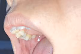 Phát hiện sớm bệnh hiểm từ các nốt sắc tố sậm màu trong miệng