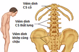 Viêm cột sống dính khớp, lúc nào cần dùng thuốc?
