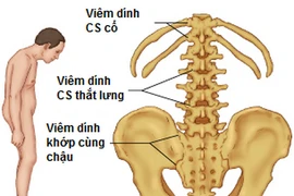 Viêm cột sống dính khớp, lúc nào cần dùng thuốc?