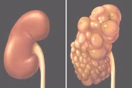 Bệnh thận đa nang và các biến chứng