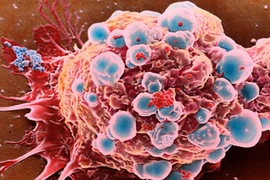 Video: Bác sĩ Mỹ tiết lộ phương pháp chống ung thư rẻ nhất