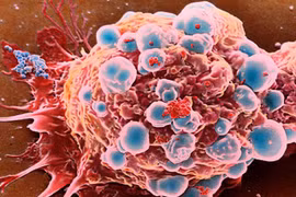 Video: Bác sĩ Mỹ tiết lộ phương pháp chống ung thư rẻ nhất