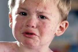 Bác sĩ Viện Nhi TƯ chỉ ra cách phân biệt bệnh sởi và sốt phát ban