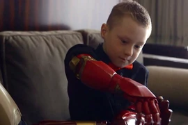 Em bé khuyết tật 7 tuổi được lắp cánh tay siêu nhân