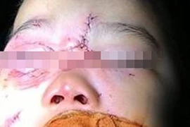 Chó nhà nổi đóa cắn rách mặt bé trai 3 tuổi