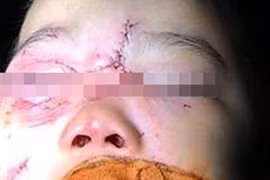 Chó nhà nổi đóa cắn rách mặt bé trai 3 tuổi