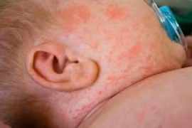 Dịch sởi nghiêm trọng nhất trong nhiều năm tại Mỹ