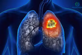 Ô nhiễm không khí và ung thư phổi có liên quan mật thiết