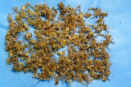 Nam bệnh nhân bị tắc ruột do nuốt hàng ngàn mảnh xương rắn