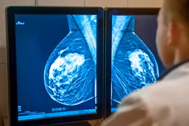 Anh cấp phép sử dụng thuốc điều trị ung thư vú giai đoạn tiến triển