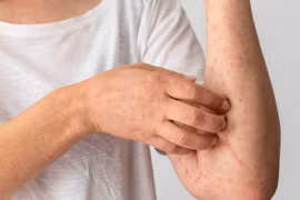 Nhiều bệnh da liễu phát triển trong mùa hè