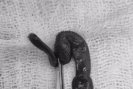 Kinh hãi con vắt dài 8cm sống trong mũi người đàn ông