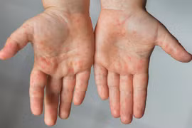 TP HCM có 476 ca mắc bệnh chân tay miệng trong tuần qua