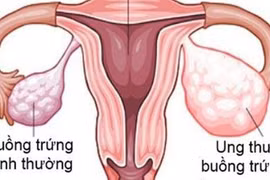 Dấu hiệu cảnh báo sớm ung thư buồng trứng