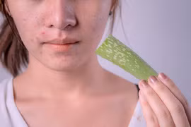 8 cách trị mụn tại nhà hiệu quả ngay lần đầu sử dụng