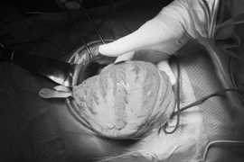 Người đàn ông “chửa phân” do phình đại tràng bẩm sinh