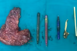 Người đàn ông bị thủng ruột vì hội chứng thích ăn đồ vật