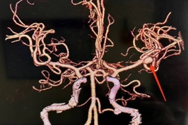 Đột ngột đau đầu sau khi tắm, người phụ nữ suýt tử vong