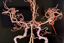 Đột ngột đau đầu sau khi tắm, người phụ nữ suýt tử vong