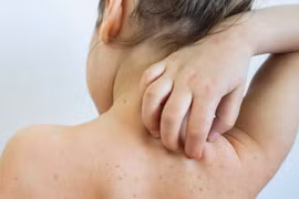 Hà Nội ghi nhận 120 ca mắc sởi trong quần qua