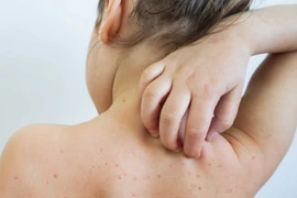 Hà Nội ghi nhận 120 ca mắc sởi trong quần qua
