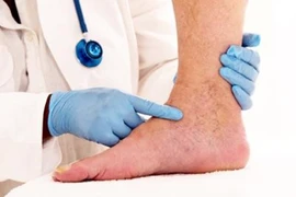 Chế độ dinh dưỡng cho người bệnh huyết khối tĩnh mạch sâu