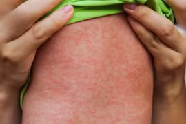 WHO kêu gọi hành động khẩn cấp ứng phó bệnh sởi