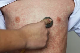 Ghi nhận 96 ca mắc sởi tại Hà Nội trong tuần qua