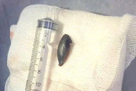 Gắp thành công hạt hồng xiêm ra khỏi phế quản cụ ông 85 tuổi