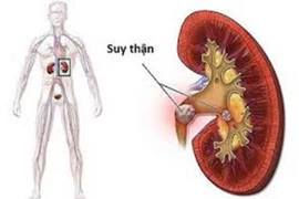 Những thói quen xấu “âm thầm” gây suy thận