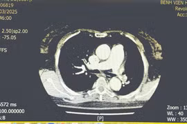 Cứu sống nữ bệnh nhân tắc động mạch phổi bằng kỹ thuật tiêu sợi huyết