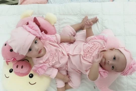 Gần 100 chuyên gia mổ tách song sinh dính nhau