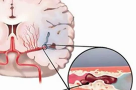 Đau nửa đầu vai gáy có phải thiếu máu não?
