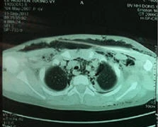 TP.HCM: Điều trị thành công ca viêm mạc hoại tử cổ mặt hiếm gặp