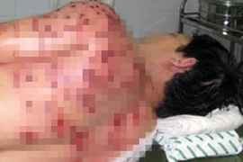 Bắt trộm, một người dân bị súng hoa cải bắn nhập viện