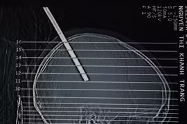 Bỗng nhiên bị cây sắt rơi trúng đầu, xuyên sâu 10cm 