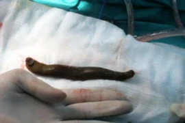 Con đỉa 20 cm sống trong bàng quang bé trai