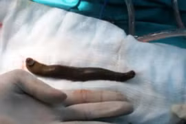 Con đỉa 20 cm sống trong bàng quang bé trai