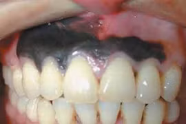 Mắc ung thư da hắc tố hiếm trong miệng