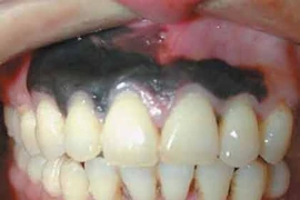 Mắc ung thư da hắc tố hiếm trong miệng